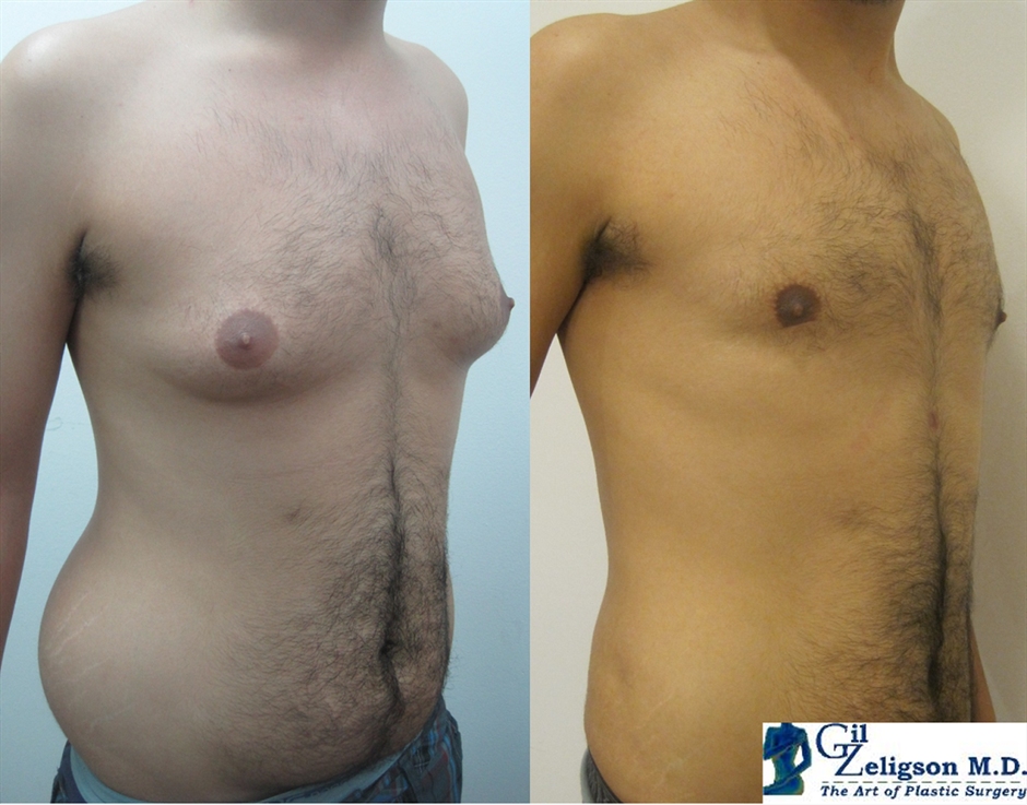 Dr. Gil Zeligson - Gynecomasty
