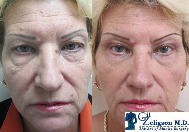 Dr. Gil Zeligson - Upper and Lower Eyelids