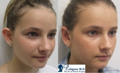 Dr. Gil Zeligson - Otoplasty