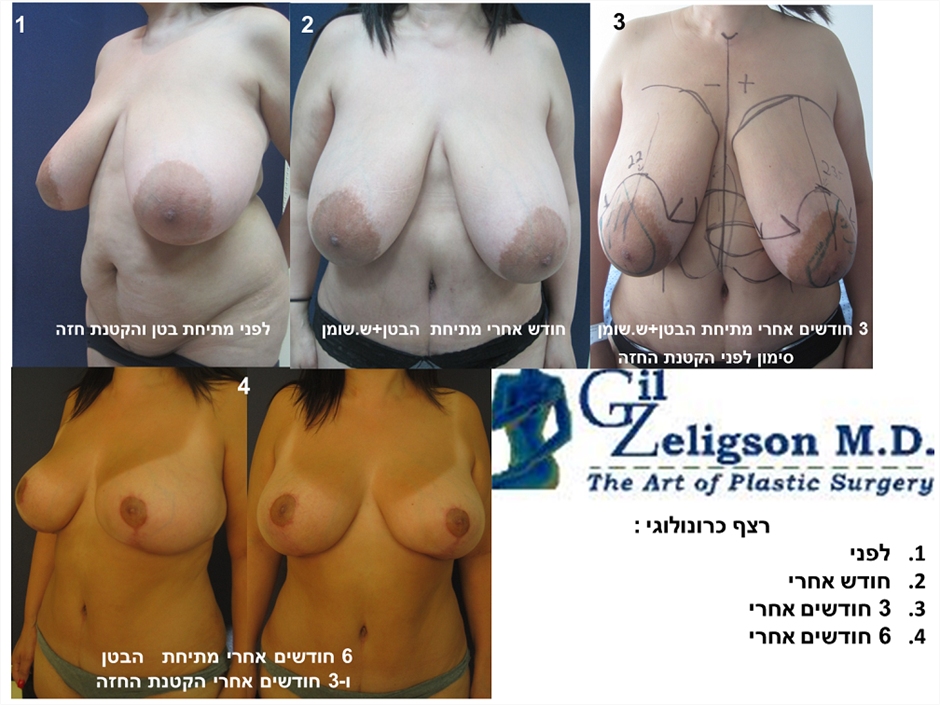Dr. Gil Zeligson - Breast Reduction