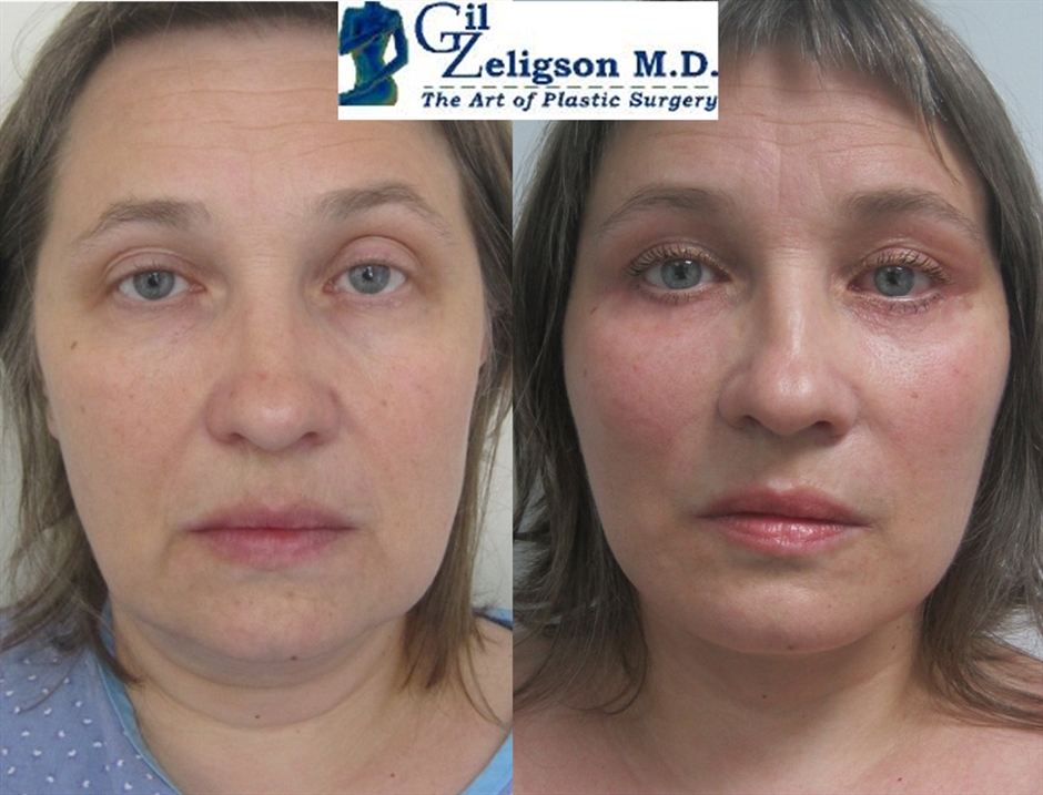 Dr. Gil Zeligson - Facelift
