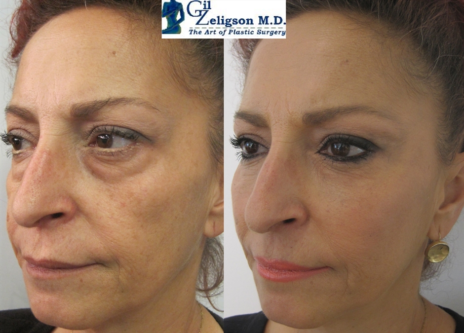 Dr. Gil Zeligson - Lips augmentaion & Wrinkles filling