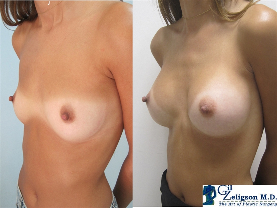 Dr. Gil Zeligson - Breast augmentation