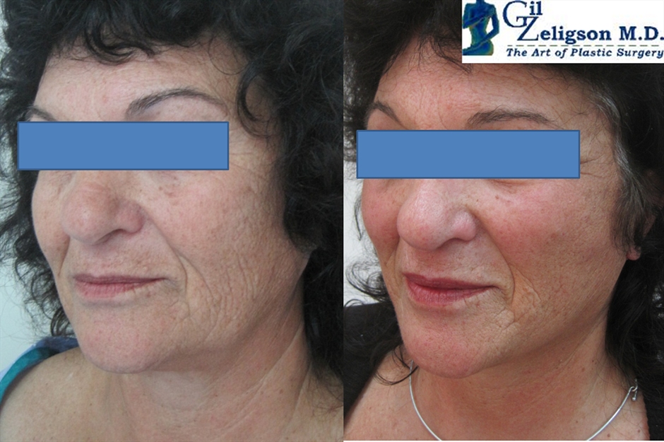 Dr. Gil Zeligson - Facelift