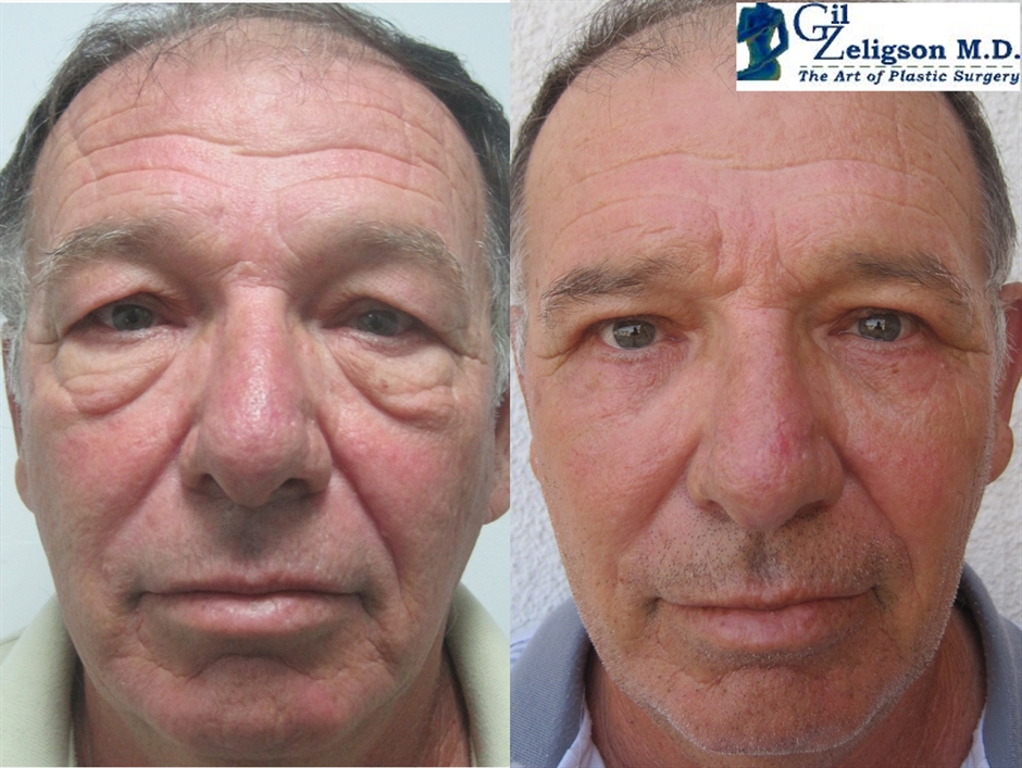 Dr. Gil Zeligson - Upper and Lower Eyelids