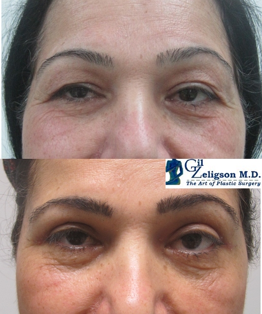 Dr. Gil Zeligson - Upper and Lower Eyelids