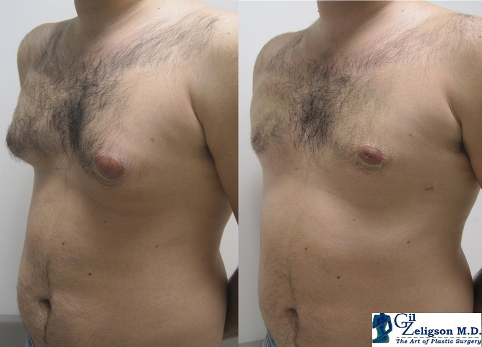 Dr. Gil Zeligson - Gynecomasty