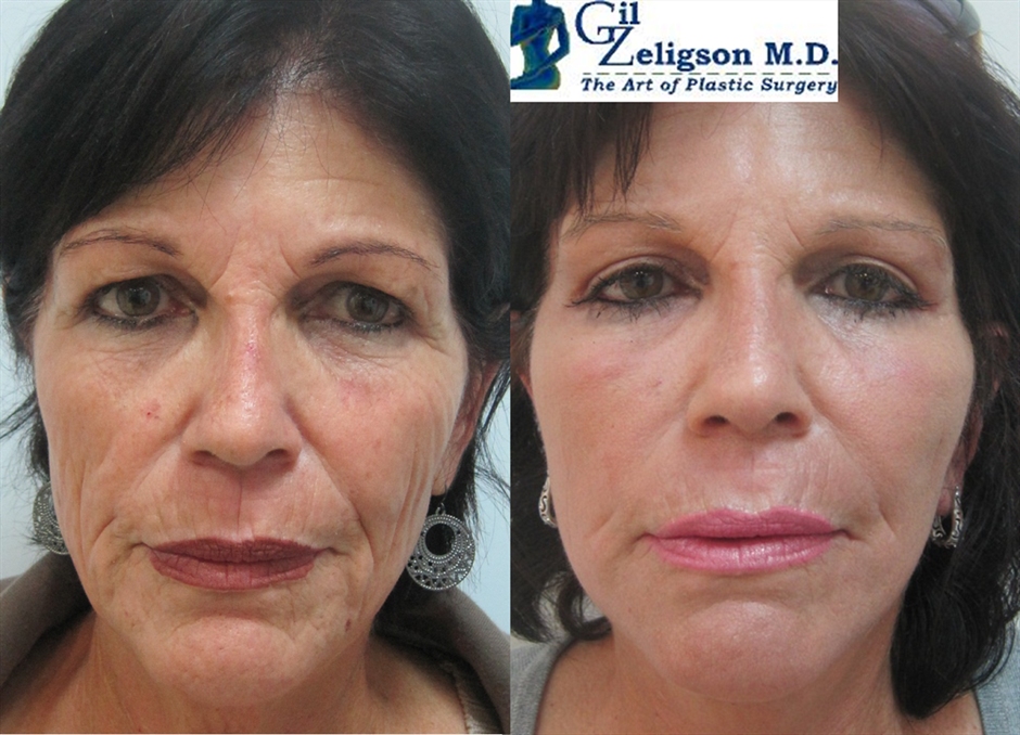Dr. Gil Zeligson - Facelift