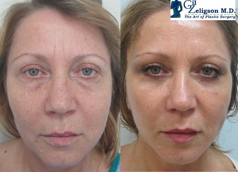 Dr. Gil Zeligson - Facelift