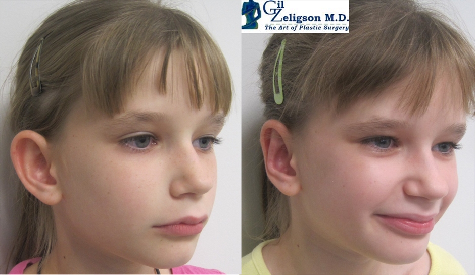 Dr. Gil Zeligson - Otoplasty