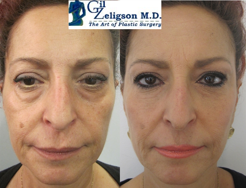 Dr. Gil Zeligson - Lips augmentaion & Wrinkles filling