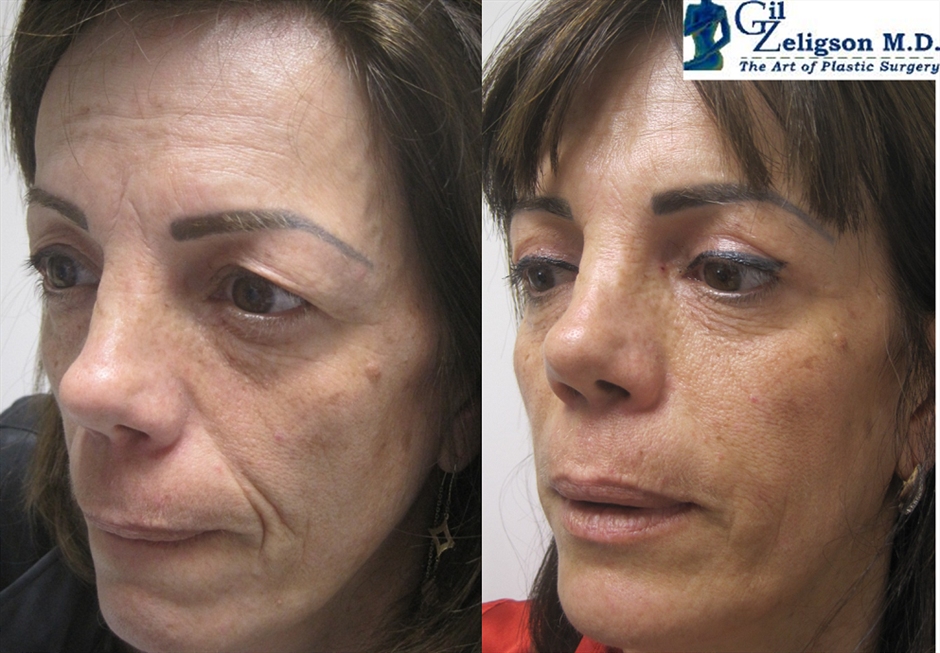 Dr. Gil Zeligson - Lips augmentaion & Wrinkles filling
