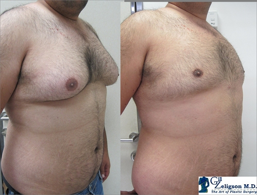 Dr. Gil Zeligson - Gynecomasty