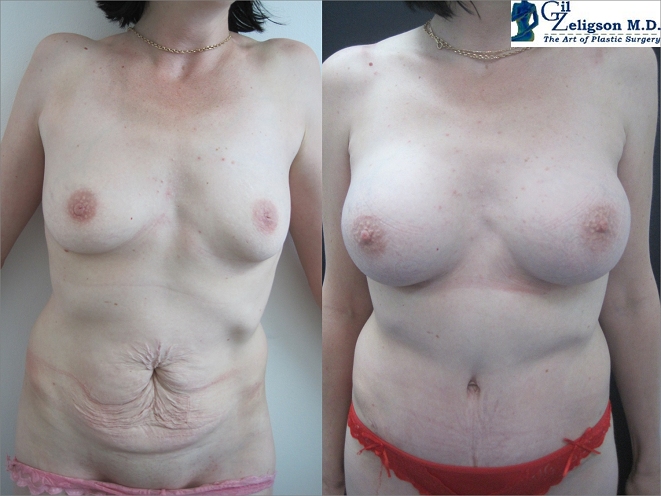 Dr. Gil Zeligson - Breast augmentation