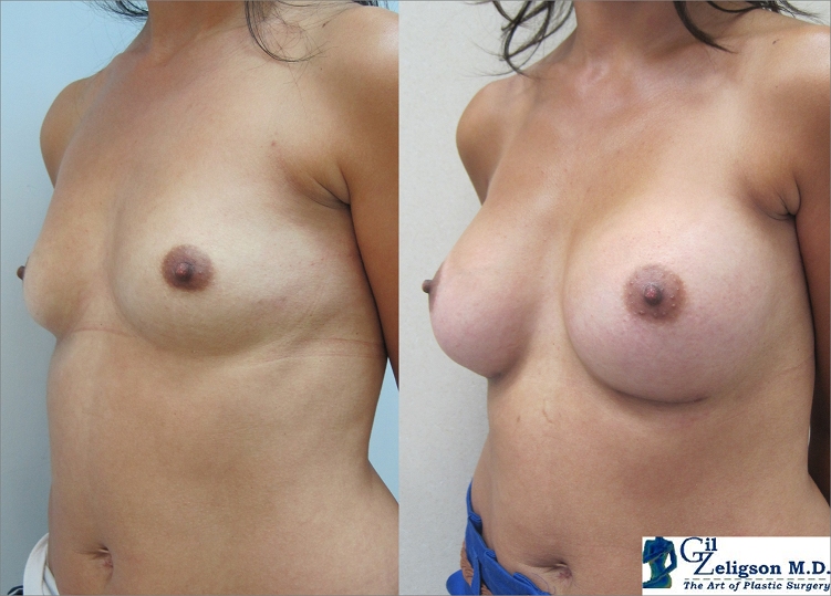 Dr. Gil Zeligson - Breast augmentation