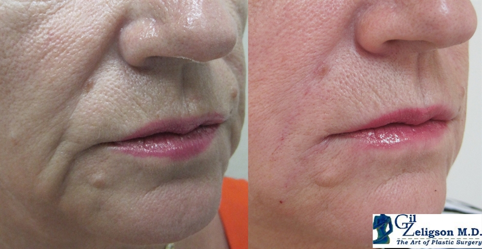 Dr. Gil Zeligson - Lips augmentaion & Wrinkles filling