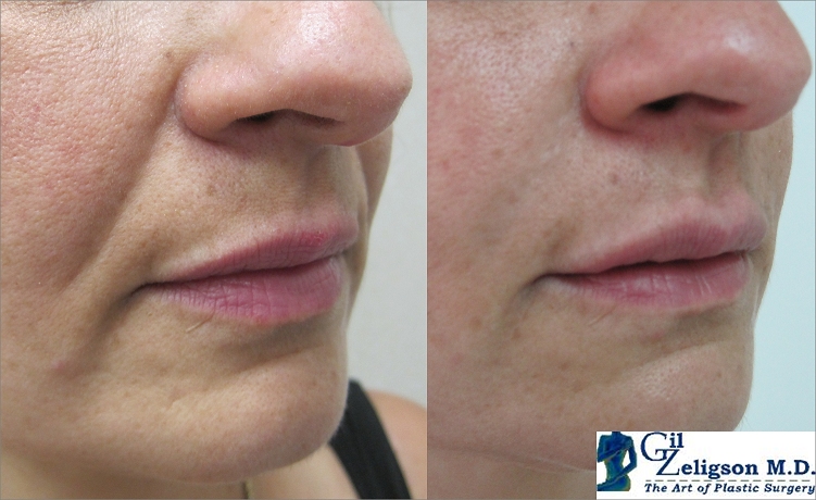 Dr. Gil Zeligson - Lips augmentaion & Wrinkles filling