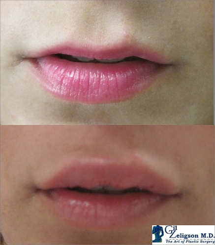 Dr. Gil Zeligson - Lips augmentaion & Wrinkles filling