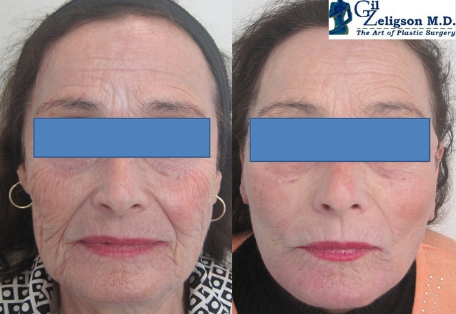 Dr. Gil Zeligson - Facelift