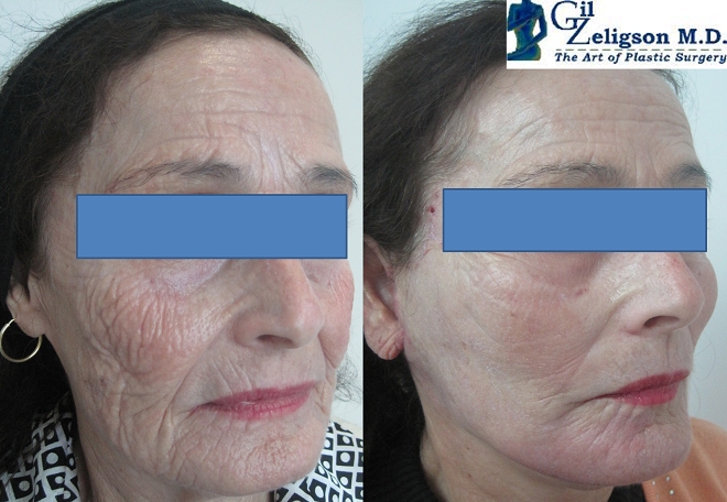 Dr. Gil Zeligson - Facelift