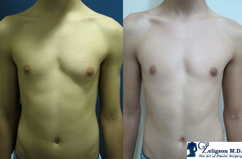 Dr. Gil Zeligson - Gynecomasty