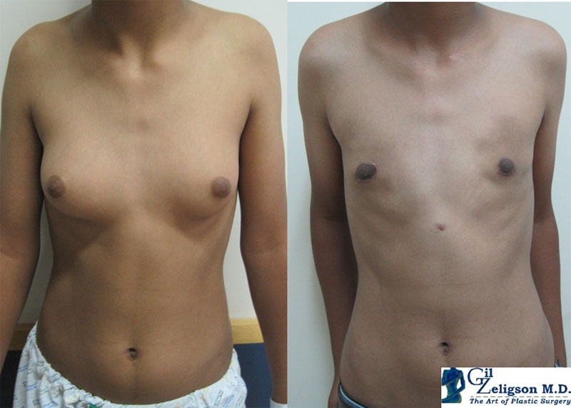 Dr. Gil Zeligson - Gynecomasty