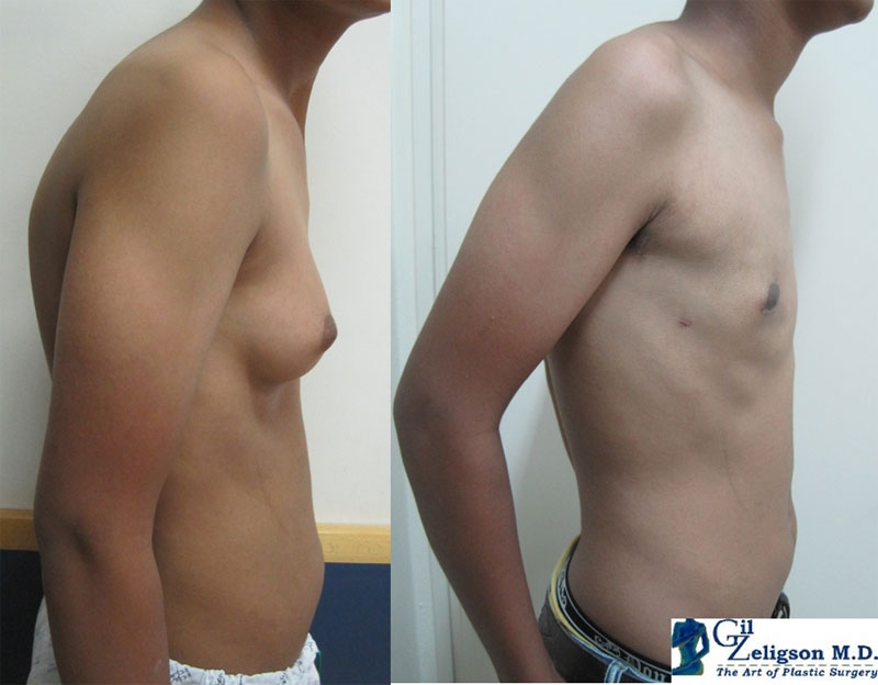 Dr. Gil Zeligson - Gynecomasty