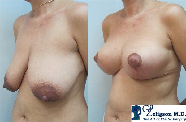 Dr. Gil Zeligson - Breast Reduction
