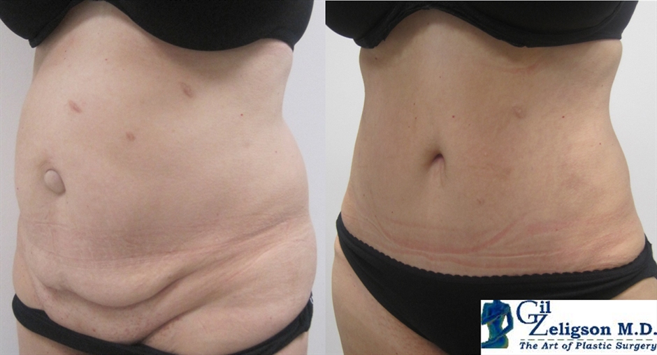 Dr. Gil Zeligson - Tummy Tuck Abdomino plasty