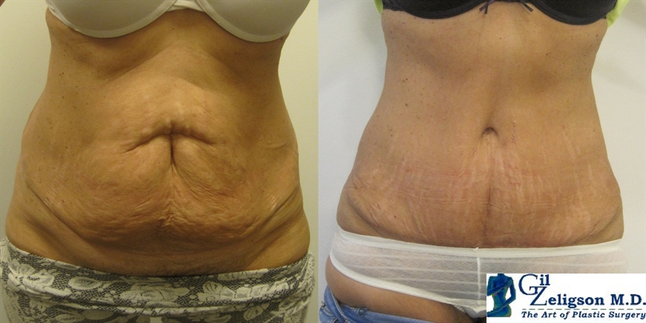 Dr. Gil Zeligson - Tummy Tuck Abdomino plasty