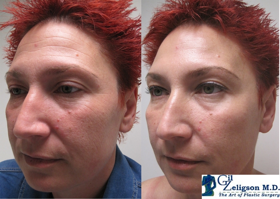 Dr. Gil Zeligson - Facial Sculpturing Hyaluronic acid