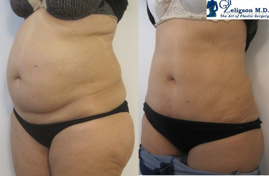 Dr. Gil Zeligson - Tummy Tuck Abdomino plasty