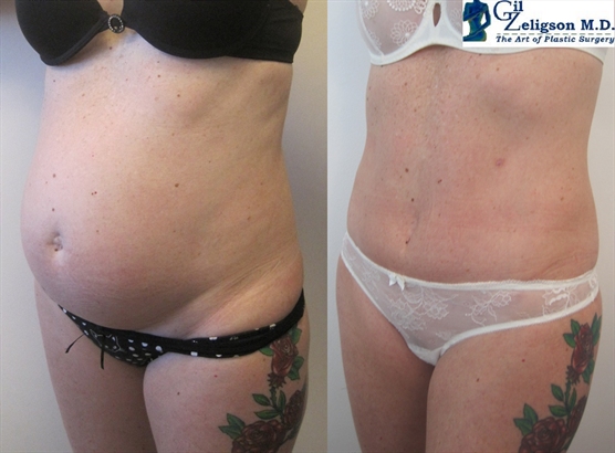 Dr. Gil Zeligson - Tummy Tuck Abdomino plasty