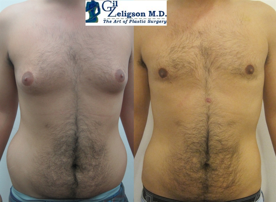 Dr. Gil Zeligson - Liposuction