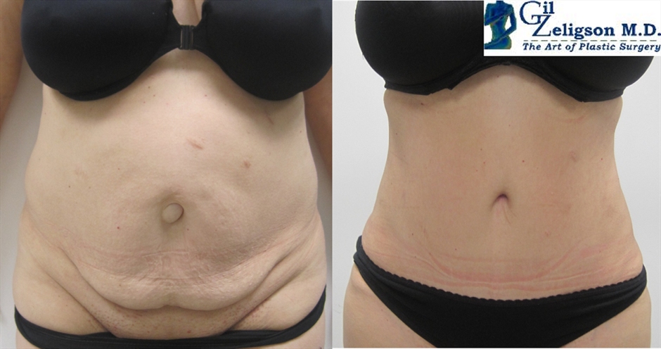 Dr. Gil Zeligson - Tummy Tuck Abdomino plasty