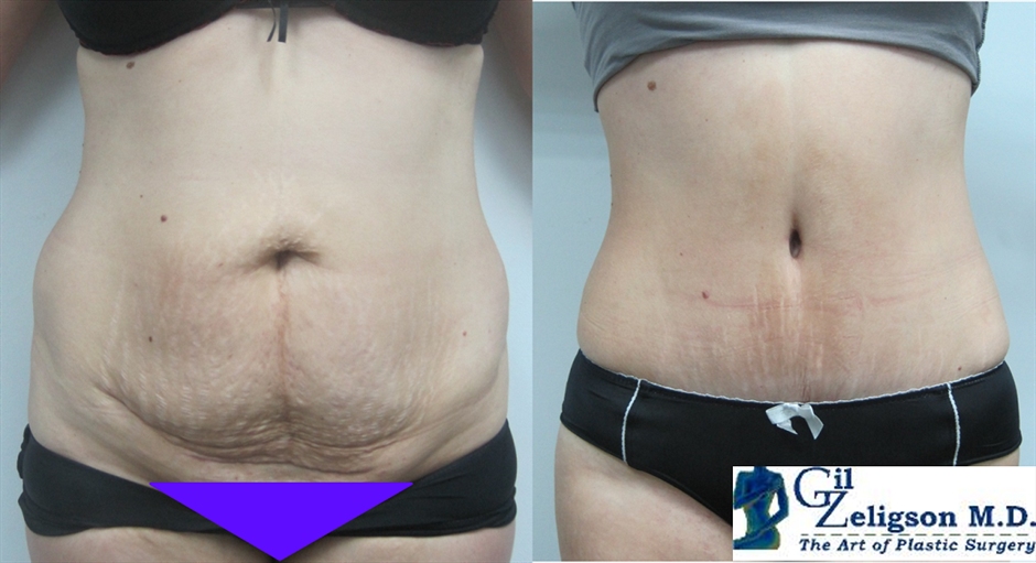 Dr. Gil Zeligson - Tummy Tuck Abdomino plasty