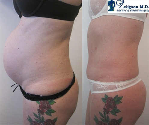 Dr. Gil Zeligson - Tummy Tuck Abdomino plasty