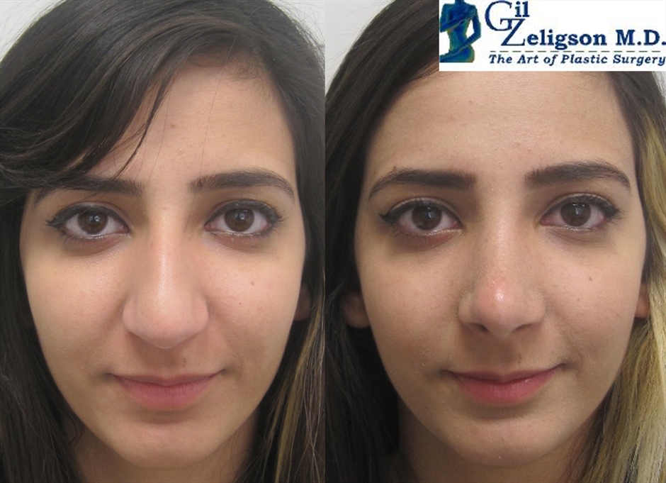 Dr. Gil Zeligson - Rhinoplasty