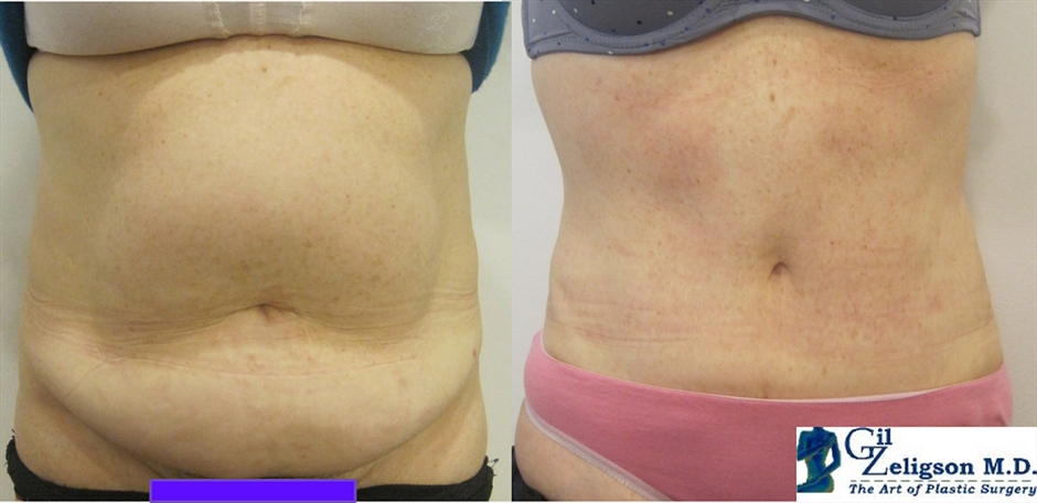 Dr. Gil Zeligson - Tummy Tuck Abdomino plasty
