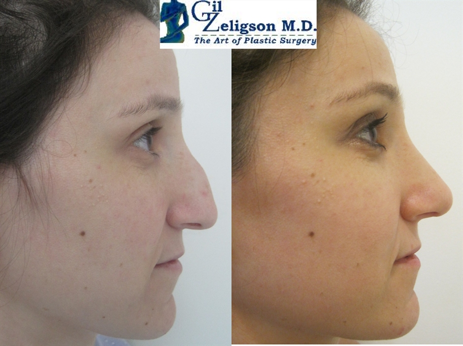 Dr. Gil Zeligson - Rhinoplasty