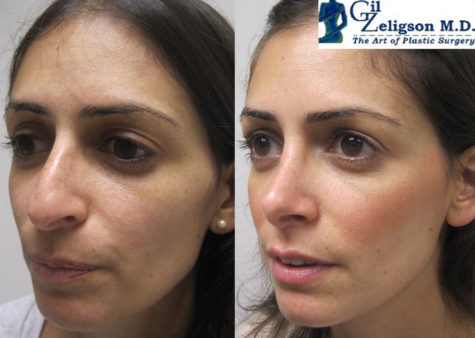 Dr. Gil Zeligson - Rhinoplasty