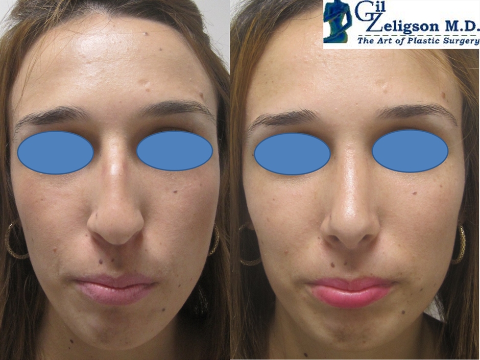 Dr. Gil Zeligson - Rhinoplasty