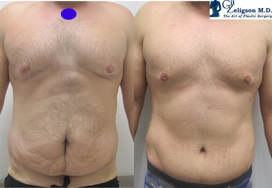 Dr. Gil Zeligson - Tummy Tuck Abdomino plasty