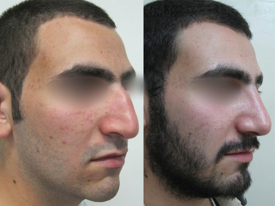 Dr. Gil Zeligson - Rhinoplasty