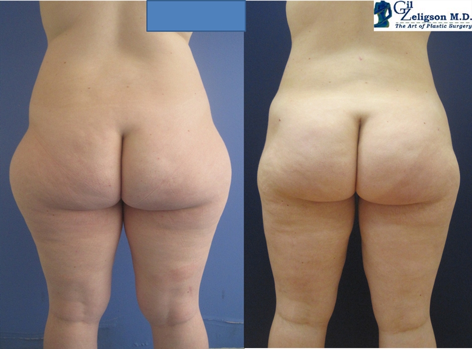 Dr. Gil Zeligson - Liposuction