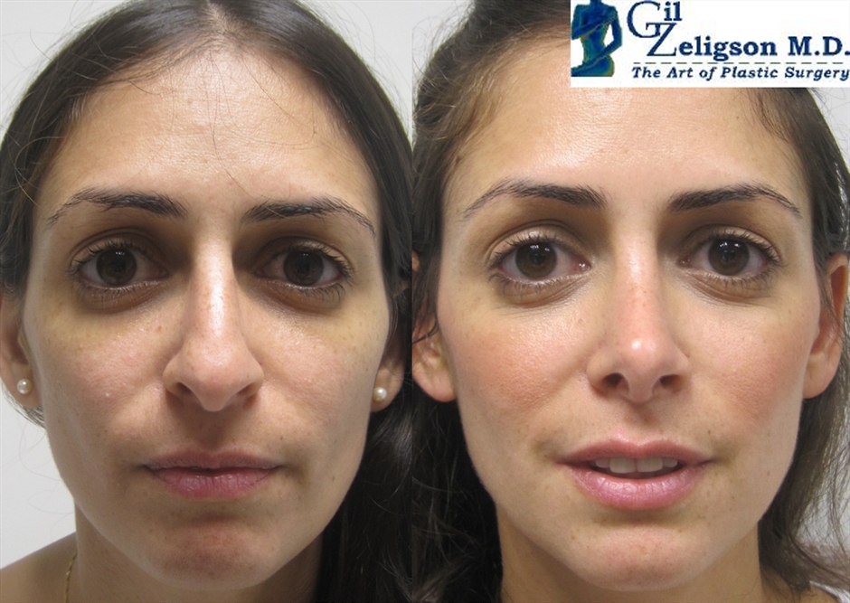 Dr. Gil Zeligson - Rhinoplasty