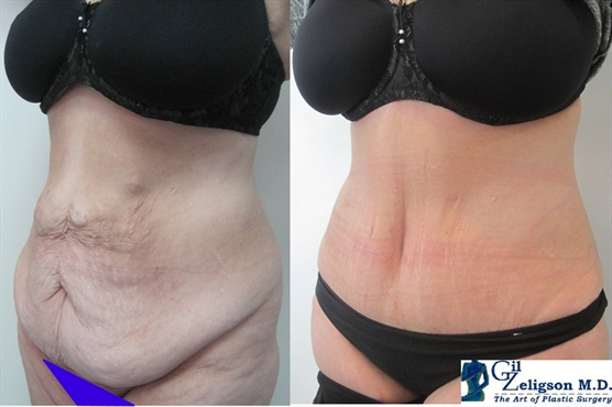 Dr. Gil Zeligson - Tummy Tuck Abdomino plasty