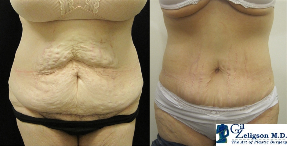 Dr. Gil Zeligson - Tummy Tuck Abdomino plasty
