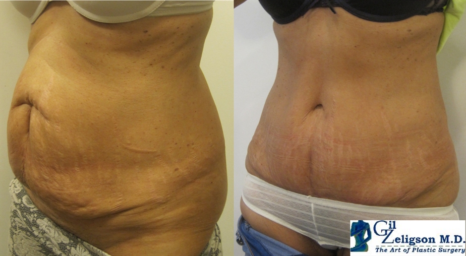 Dr. Gil Zeligson - Tummy Tuck Abdomino plasty