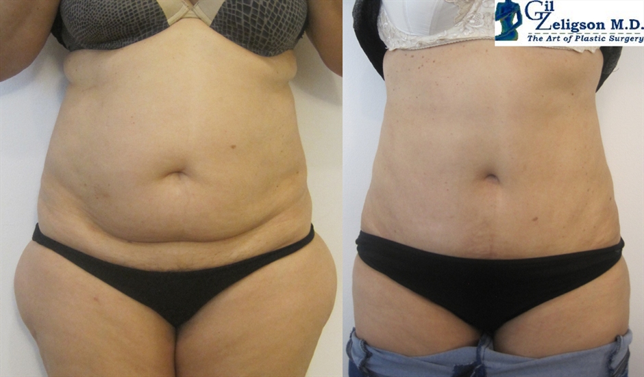 Dr. Gil Zeligson - Tummy Tuck Abdomino plasty